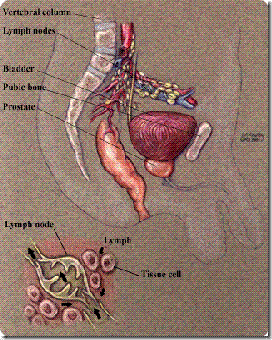 LYMPH NODES OF THE PROSTATE